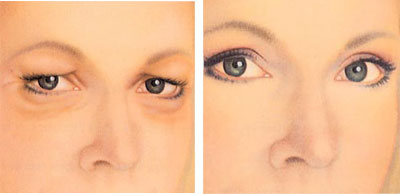 eyelid surgery abroad results